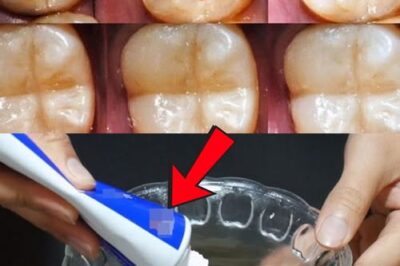 How to Naturally Repair a Cavity & Strengthen Your Teeth