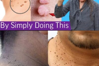 Plantar Warts and Skin Tags Disappear Overnight with this recipe