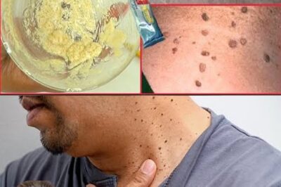 Plantar Warts and Skin Tags Disappear Naturally—Try This Overnight Remedy